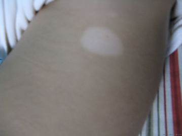 武汉了解白癜风早期什么症状很重要 武汉白癜风初期什么症状表现