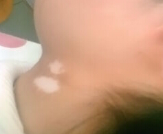 武汉正规治白癜风医院 武汉正规治白癜风的医院