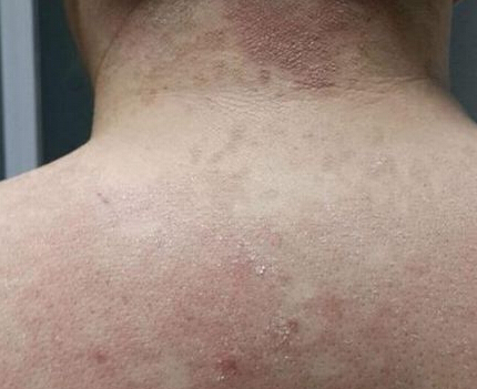 如何避免白癜风 青少年白癜风预防很重要