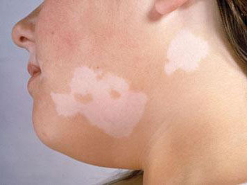 武汉治白癜风哪里比较好 武汉治疗白癜风哪家医院最好