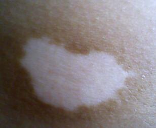 武汉吃坚果对白癜风患者有没有帮助?